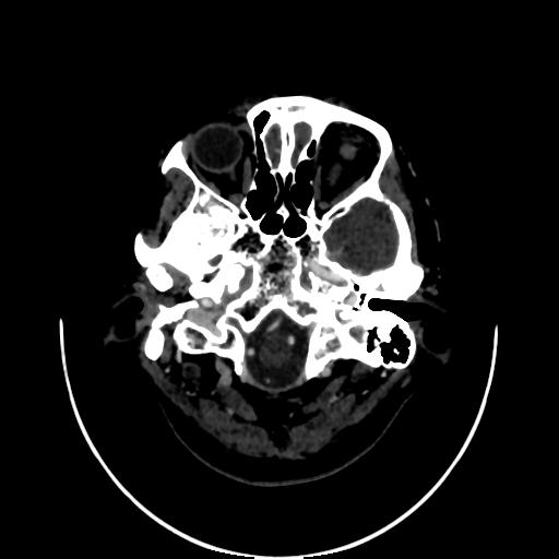 File:Cavernoma with developmental venous anomaly (Radiopaedia 22470-22506 C 8).jpg