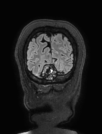 Cavernous hemangioma of the cerebellar falx (Radiopaedia 73025-83724 Coronal FLAIR 325).jpg