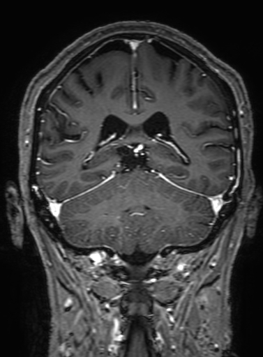 Cavernous hemangioma of the cerebellar falx (Radiopaedia 73025-83724 Coronal T1 C+ 251).jpg