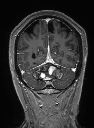 Cavernous hemangioma of the cerebellar falx (Radiopaedia 73025-83724 Coronal T1 C+ 297).jpg