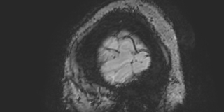 Cavernous hemangioma of the cerebellar falx (Radiopaedia 73025-83724 Sagittal BOLD 9).jpg