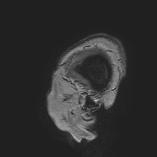 File:Cavernous hemangioma of the cerebellar falx (Radiopaedia 73025-83724 Sagittal T1 9).jpg