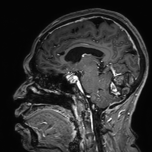 Cavernous hemangioma of the cerebellar falx (Radiopaedia 73025-83724 Sagittal T1 C+ 116).jpg