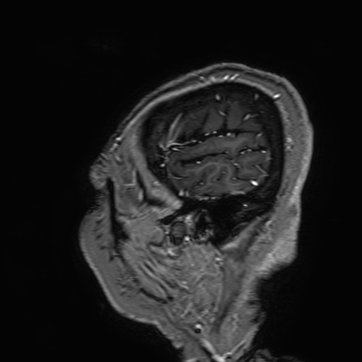 File:Cavernous hemangioma of the cerebellar falx (Radiopaedia 73025-83724 Sagittal T1 C+ 20).jpg