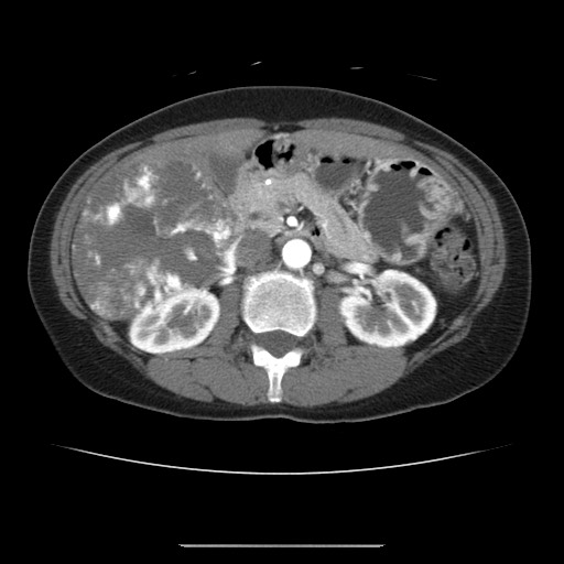 File:Cavernous hepatic hemangioma (Radiopaedia 75441-86667 A 46).jpg