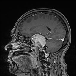 Cavernous sinus meningioma (Radiopaedia 63682-72367 Sagittal T1 C+ 77).jpg