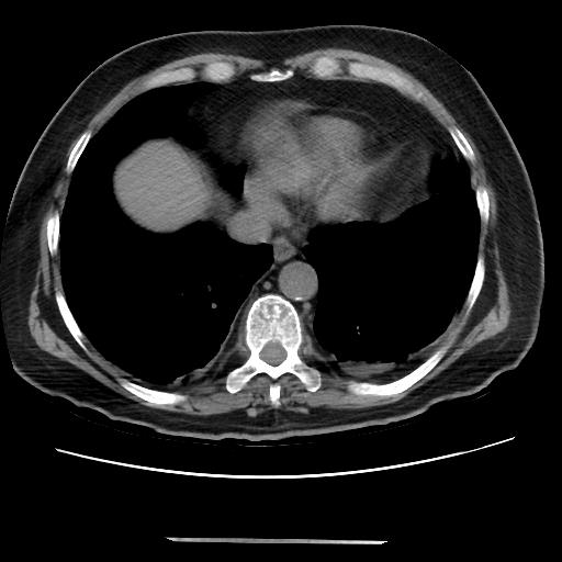 Cavitating pulmonary metastases (Radiopaedia 89545-106544 Axial non-contrast 42).jpg