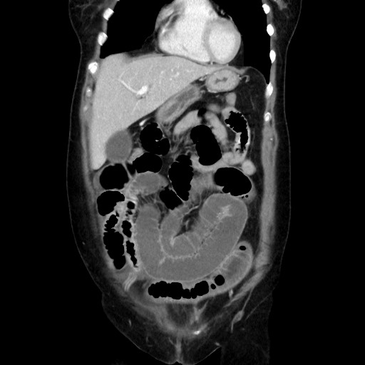 Cecal adenocarcinoma (Radiopaedia 75909-87331 B 16).jpg