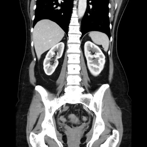 Cecal adenocarcinoma (Radiopaedia 75909-87331 B 34).jpg