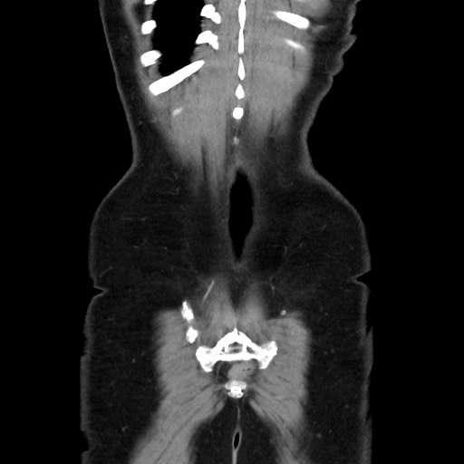 Cecal adenocarcinoma (Radiopaedia 75909-87331 B 45).jpg