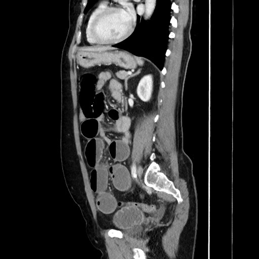 Cecal adenocarcinoma (Radiopaedia 75909-87331 C 46).jpg