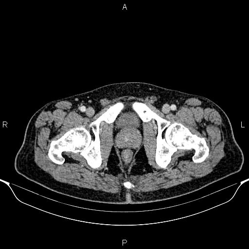 Cecal adenocarcinoma (Radiopaedia 85324-100916 B 99).jpg