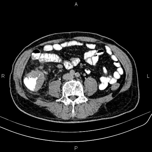 File:Cecal cancer with appendiceal mucocele (Radiopaedia 91080-108651 Axial C+ delayed 43).jpg