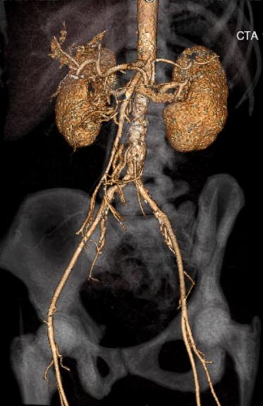 File:Celiac artery severe stenosis and dissection (Radiopaedia 44128-47842 C+ arterial phase 27).jpg