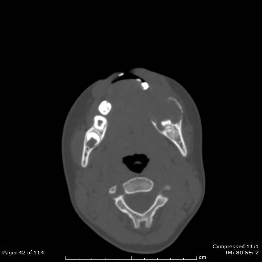 File:Central giant cell granuloma (Radiopaedia 45612-49754 Axial bone window 21).jpg