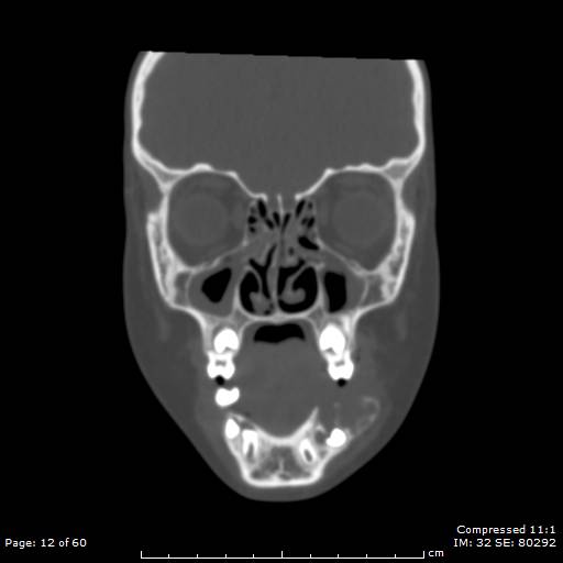 Central giant cell granuloma (Radiopaedia 45612-49754 Coronal bone window 12).jpg
