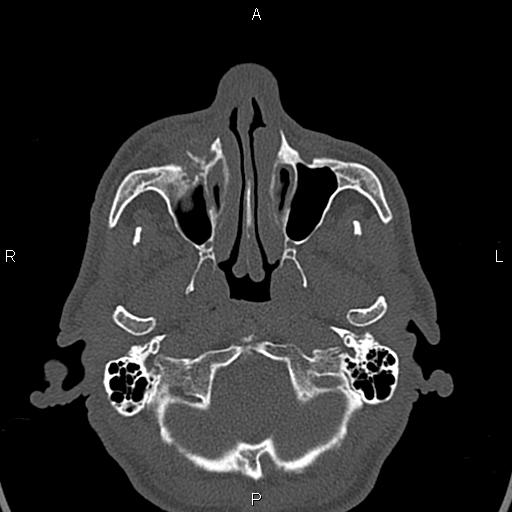 File:Central giant cell granuloma (Radiopaedia 83346-97761 Axial bone window 38).jpg