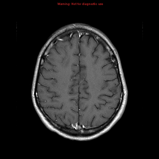 File:Central nervous system vasculitis (Radiopaedia 8410-9235 Axial T1 C+ 18).jpg