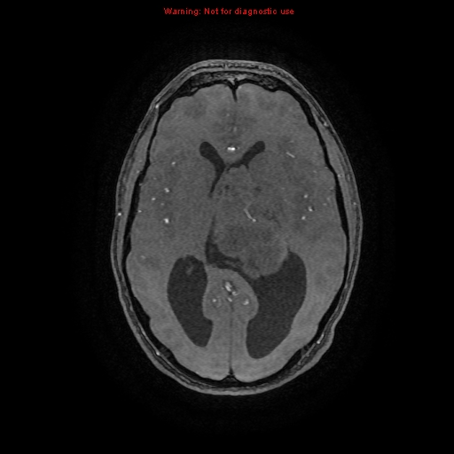Central neurocytoma (Radiopaedia 13188-13206 Axial MRA 42).jpg