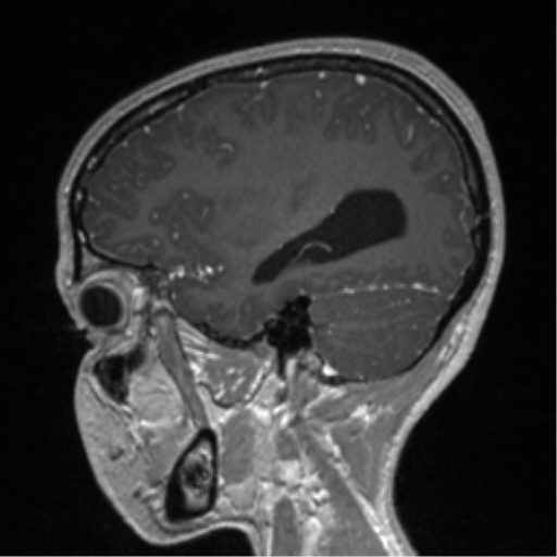 Central neurocytoma (Radiopaedia 37664-39557 Sagittal T1 C+ 28).png