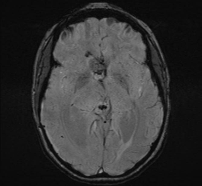 Central neurocytoma (Radiopaedia 70263-80336 Axial SWI 26).jpg