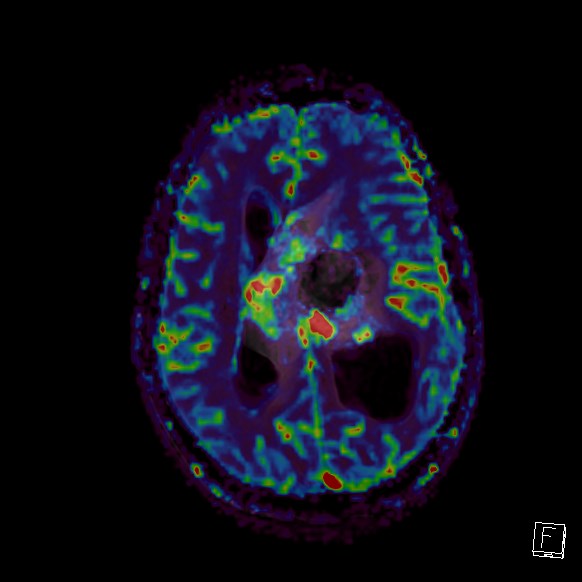 Central neurocytoma (Radiopaedia 84497-99872 Axial Perfusion 127).jpg