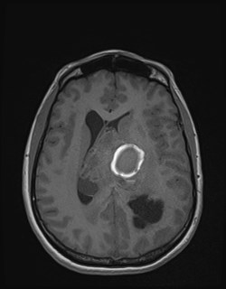 File:Central neurocytoma (Radiopaedia 84497-99872 Axial T1 120).jpg