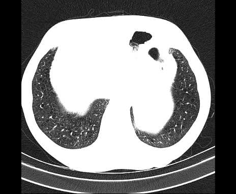 Centrilobular pulmonary emphysema (Radiopaedia 62468-70718 Axial lung window 68).jpg