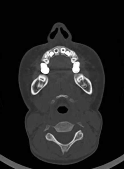 Cerebellar abscess (Radiopaedia 73727-84527 Axial bone window 4).jpg