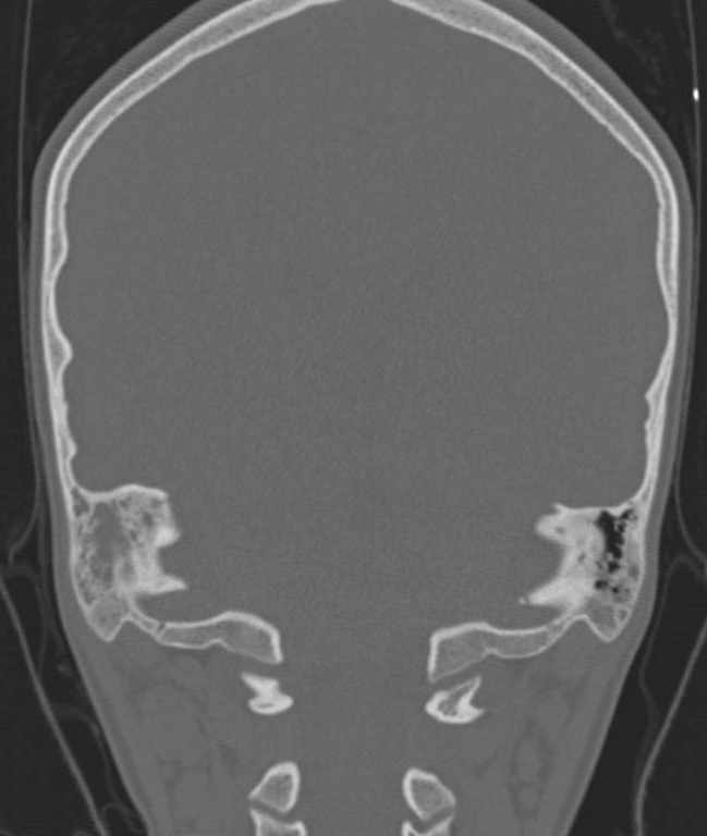 Cerebellar abscess (Radiopaedia 73727-84527 Coronal bone window 34).jpg