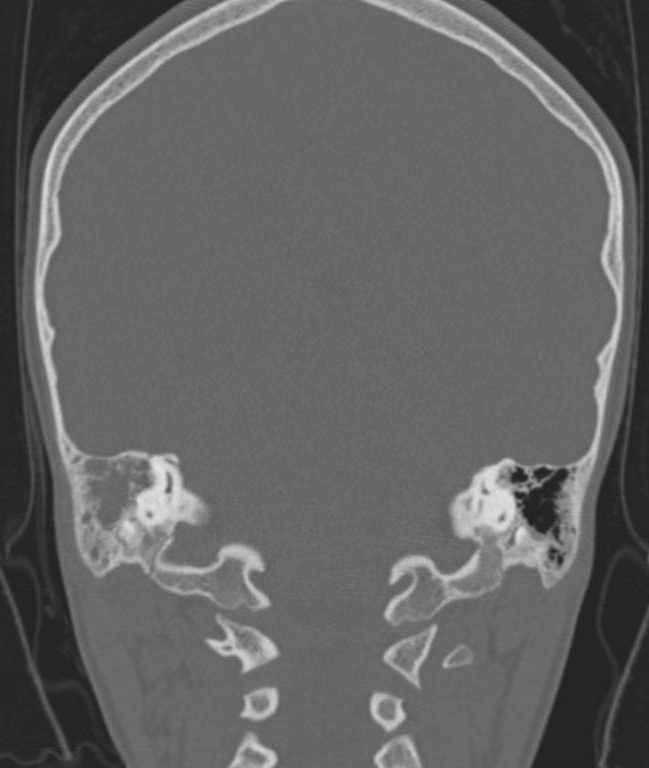 Cerebellar abscess (Radiopaedia 73727-84527 Coronal bone window 43).jpg
