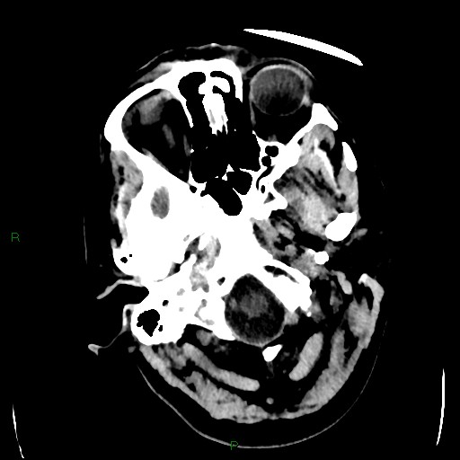 Cerebellar abscess (Radiopaedia 78135-90671 Axial non-contrast 12).jpg