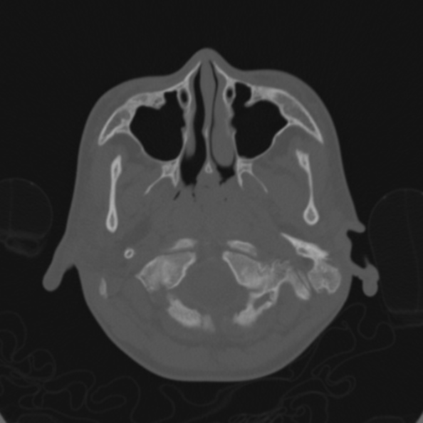 File:Cerebellar abscess secondary to mastoiditis (Radiopaedia 26284-26413 Axial bone window 16).jpg
