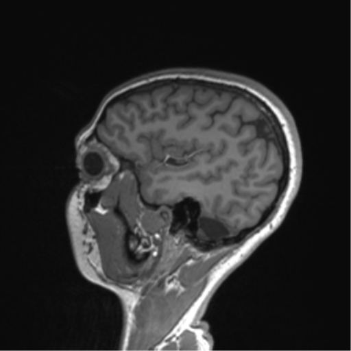 Cerebellar agenesis with hypoplastic pons (pontocerebellar hypoplasia) (Radiopaedia 57224-64138 Sagittal T1 51).png