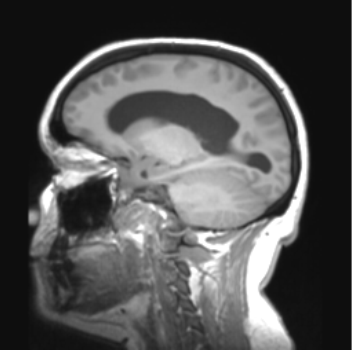 File:Cerebellar ependymoma complicated by post-operative subdural hematoma (Radiopaedia 83322-97736 Sagittal T1 17).png