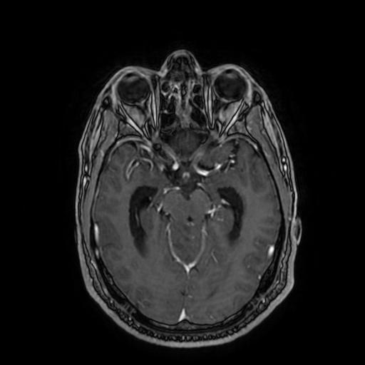 Cerebellar hemangioblastoma (Radiopaedia 88055-104622 Axial T1 C+ 80).jpg