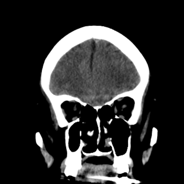Cerebellar hemorrhage causing obstructive hydrocephalus (Radiopaedia 33989-35207 Coronal non-contrast 15).jpg