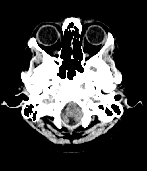 File:Cerebellar metastases - colorectal adenocarcinoma (Radiopaedia 40947-43652 Axial non-contrast 7).png