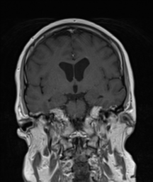 File:Cerebellar metastasis (Radiopaedia 54578-60810 Coronal T1 C+ 18).png