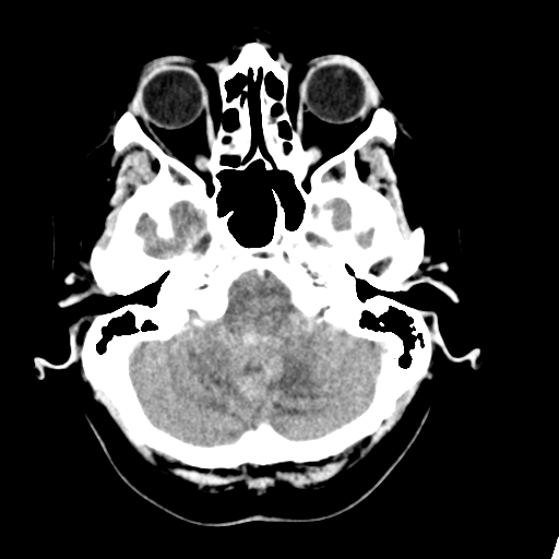 Cerebellar metastasis (Radiopaedia 54578-60812 Axial C+ 10).png