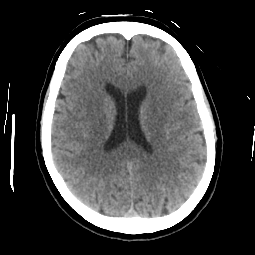 Cerebellar metastasis (cystic appearance) (Radiopaedia 41395-44258 Axial non-contrast 33).png