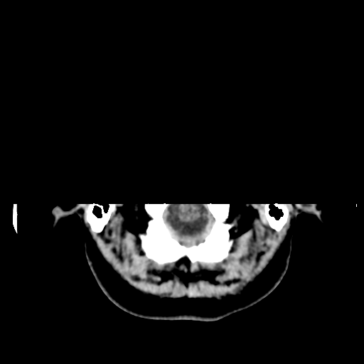 File:Cerebellar metastasis (cystic appearance) (Radiopaedia 41395-44258 Axial non-contrast 5).png