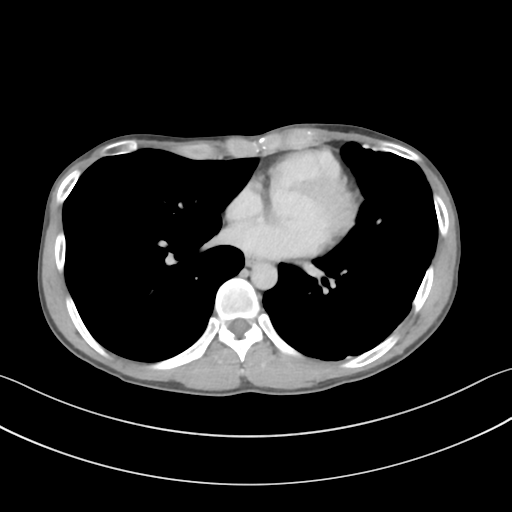 Cerebellar metastasis - adenocarcinoma lung (Radiopaedia 63184-71717 Axial C+ delayed 42).png