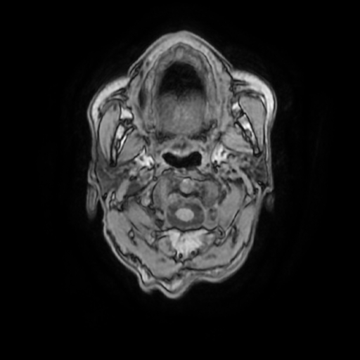 File:Cerebellar metastasis - lung tumor (Radiopaedia 69317-79147 Axial T1 2).jpg