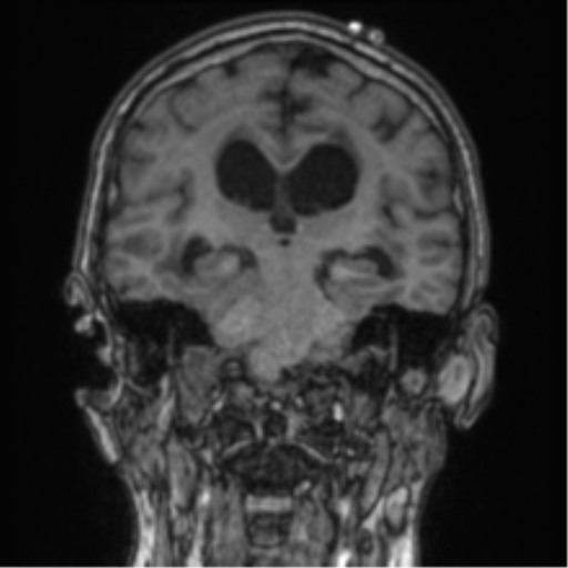 Cerebellar metastasis from lung adenocarcinoma (Radiopaedia 86690-102829 Coronal T1 47).png