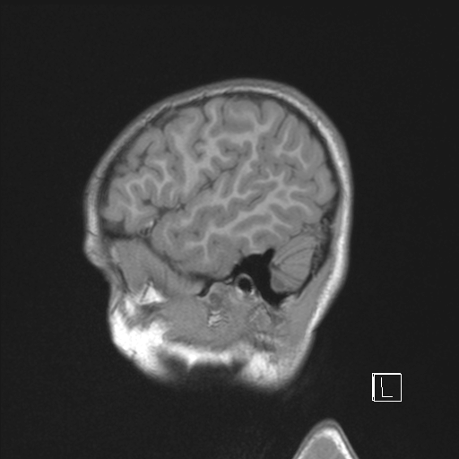 File:Cerebellar stroke (Radiopaedia 32202-33150 Sagittal T1 C+ 45).png