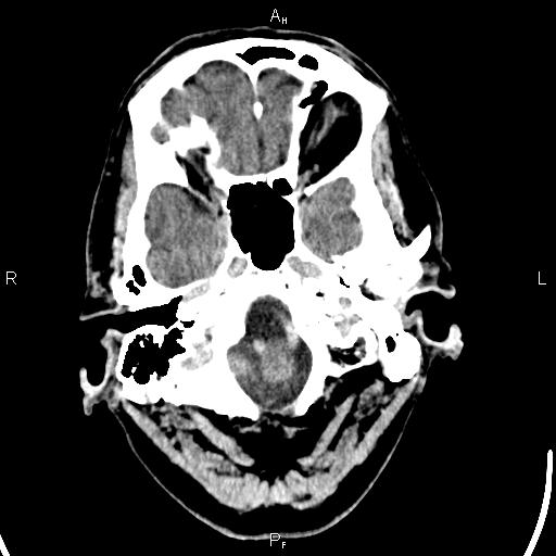 Cerebellopontine angle arachnoid cyst (Radiopaedia 85149-100704 Axial With contrast 5).jpg