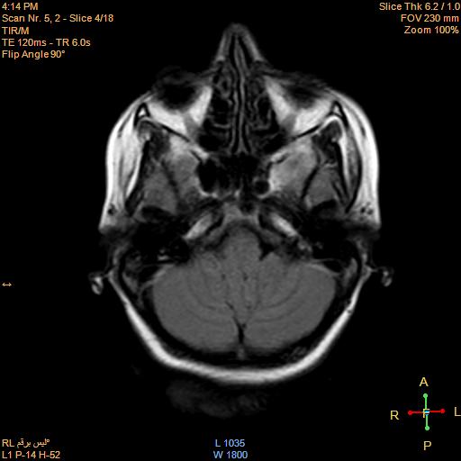 File:Cerebellopontine angle meningioma (Radiopaedia 22488-22525 Axial FLAIR 2).jpg