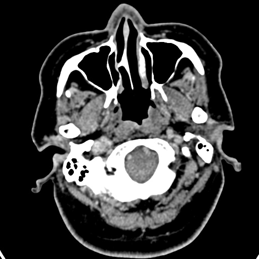 Cerebellopontine angle meningioma (Radiopaedia 35181-36714 A 54).jpg