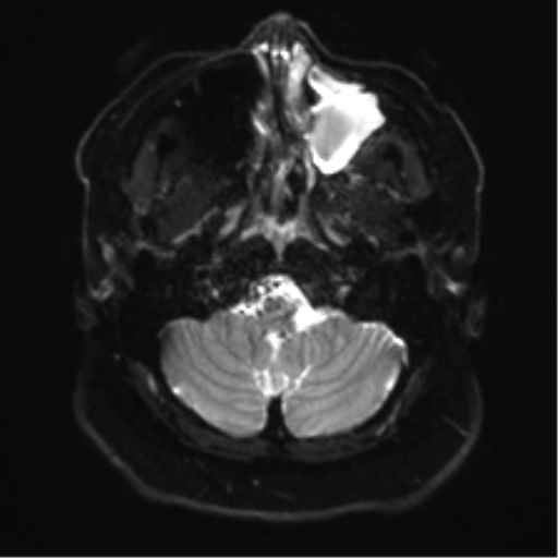 Cerebellopontine angle meningioma (Radiopaedia 48434-53348 Axial DWI 5).png
